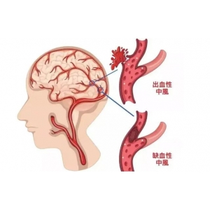 為什么中國腦梗越來越多，美國卻在減少？醫(yī)生：主要原因有這3點(diǎn)